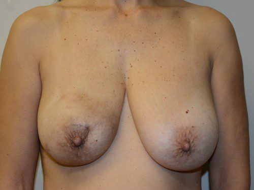 Breast Reconstruction TRAM Flap Before Patient 1