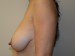 Breast Reconstruction TRAM Flap Before Patient Thumbnail 3