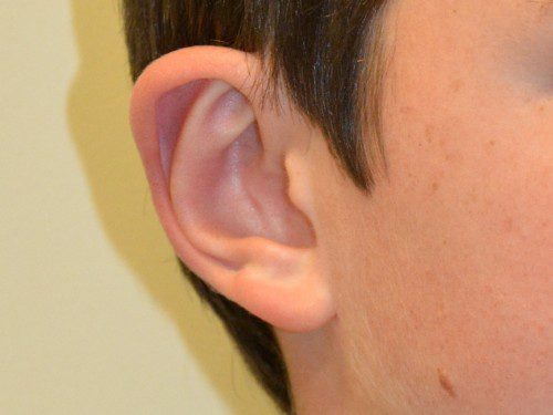 Prominent Ear Surgery After Patient 4
