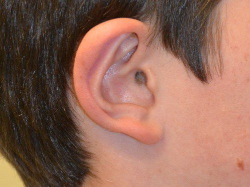 Prominent Ear Surgery After Patient 5