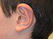 Prominent Ear Surgery After Patient Thumbnail 3