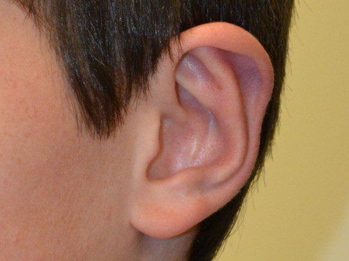 Prominent Ear Surgery After Patient 2