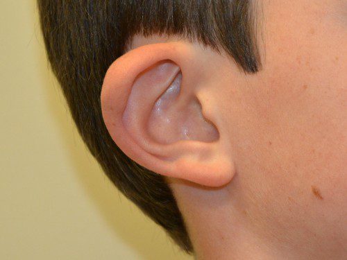 Prominent Ear Surgery Before Patient 4