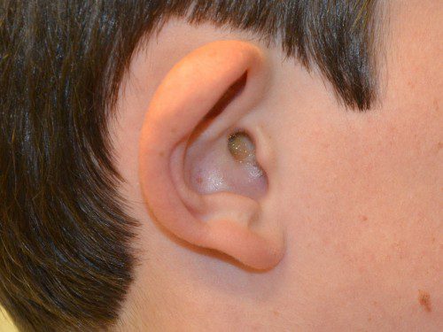 Prominent Ear Surgery Before Patient 5