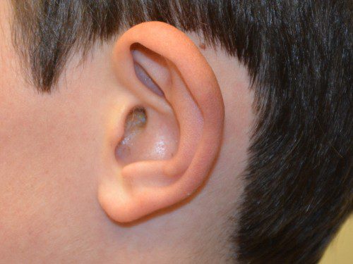 Prominent Ear Surgery Before Patient 3