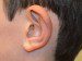Prominent Ear Surgery Before Patient Thumbnail 3