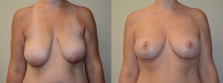 https://www.missionplasticsurgery.com/wp-content/uploads/2016/03/Breast-Lift-Before-and-After-Photos.png