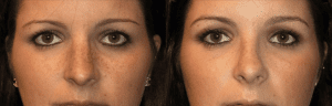 Rhinoplasty Before and After