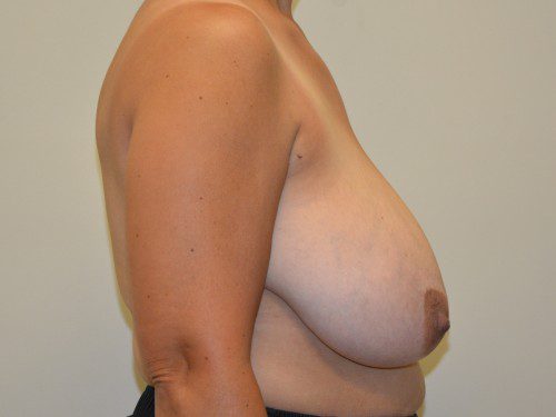 Breast Reduction Before Patient 3