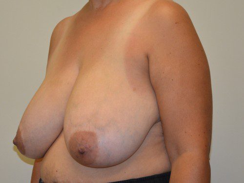 Breast Reduction Before Patient 4