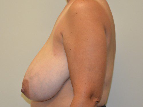 Breast Reduction Before Patient 5