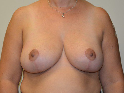 Breast Reduction After Patient 1