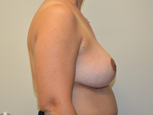 Breast Reduction After Patient 3