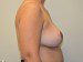 Breast Reduction After Patient Thumbnail 3