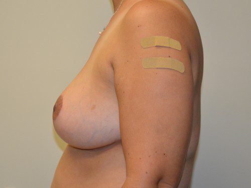 Breast Reduction After Patient 5