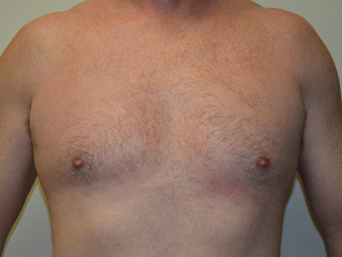 Male Breast Reduction Before Patient 1