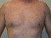 Male Breast Reduction Before Patient Thumbnail 1