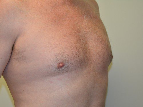 Male Breast Reduction Before Patient 2