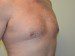 Male Breast Reduction Before Patient Thumbnail 2