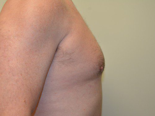 Male Breast Reduction Before Patient 3