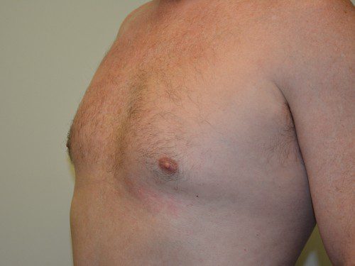 Male Breast Reduction Before Patient 4