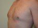 Male Breast Reduction Before Patient Thumbnail 4