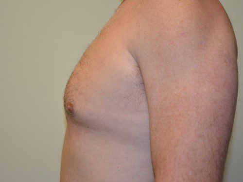 Male Breast Reduction Before Patient 5