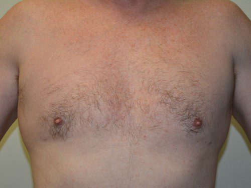 Male Breast Reduction After Patient 1