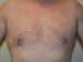 Male Breast Reduction After Patient Thumbnail 1