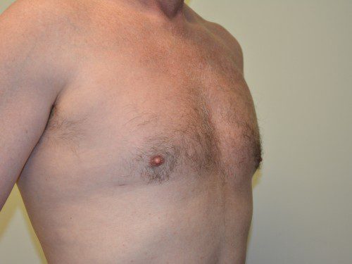 Male Breast Reduction After Patient 2