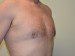 Male Breast Reduction After Patient Thumbnail 2