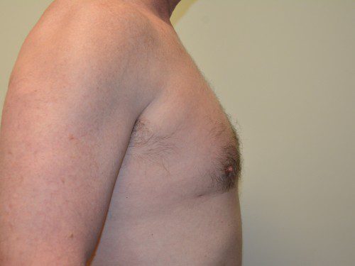 Male Breast Reduction After Patient 3