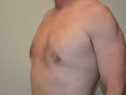 Male Breast Reduction After Patient 4