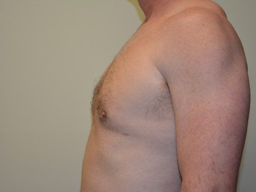 Male Breast Reduction After Patient 5