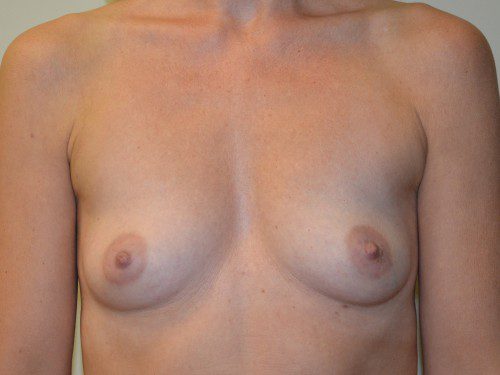 Breast Augmentation Before Patient 1