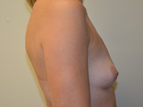 Breast Augmentation Before Patient 5