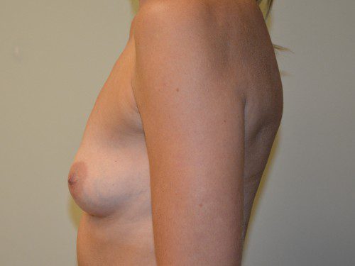 Breast Augmentation Before Patient 3