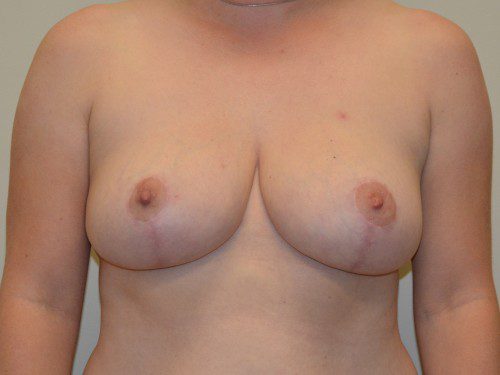 Breast Reduction After Patient 1