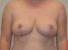 Breast Reduction After Patient Thumbnail 1