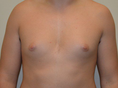 Male Breast Reduction Before Patient 1