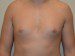 Male Breast Reduction Before Patient Thumbnail 1