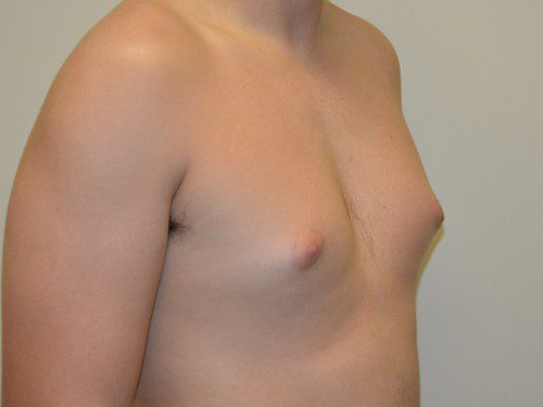Male Breast Reduction Before Patient 2