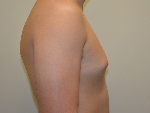 Male Breast Reduction Before Patient 3