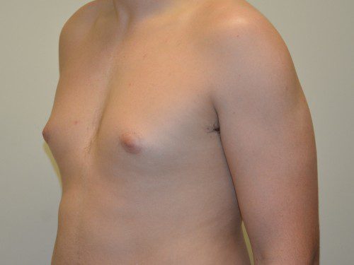 Male Breast Reduction Before Patient 4