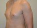 Male Breast Reduction Before Patient Thumbnail 4