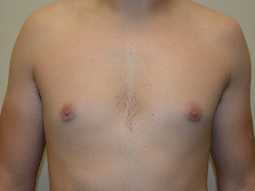 Male Breast Reduction After Patient 1