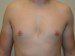 Male Breast Reduction After Patient Thumbnail 1