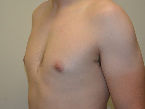 Male Breast Reduction After Patient 4