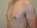 Male Breast Reduction After Patient Thumbnail 4