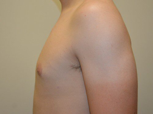 Male Breast Reduction After Patient 5